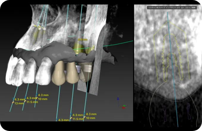 インプラント治療イメージ3